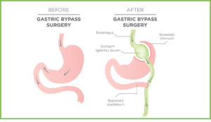 MINI GASTRIC BYPASS